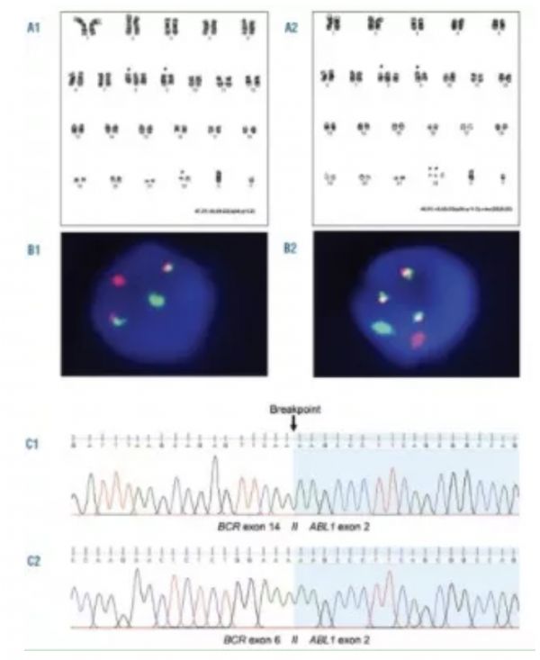 Haematologica：病例分享 | 慢性髓系白血病双费城染色体阳性同时表达P210BCR-ABL1和P195BCR-ABL1