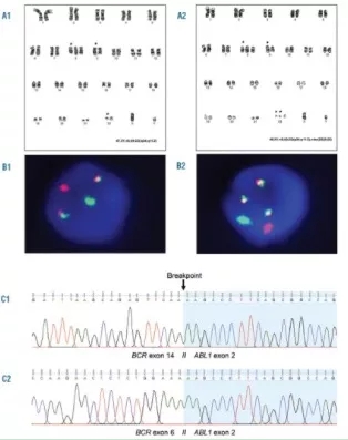 病例分享 | 慢性髓系白血病双费城染色体阳性同时表达P210BCR-ABL1和P195BCR-ABL1