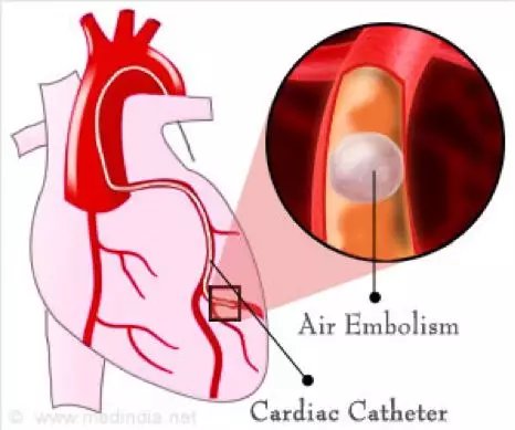 输液时多少空气进入血管会致命？