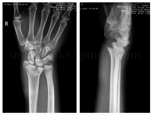 骨质疏松患者摔伤右腕肿胀畸形 哪种<font color="red">治疗</font>方案效果佳？