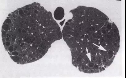 这竟然不是简单的“肺大泡”，可能是“囊性肺癌”！