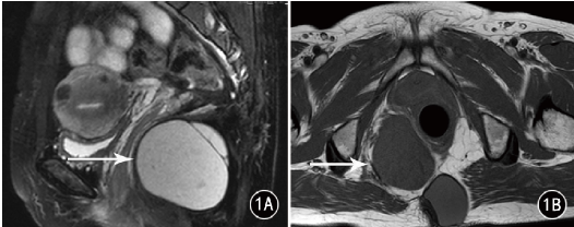骶前尾肠囊肿的MRI表现：4例报告