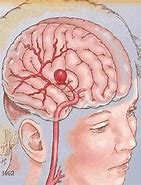 Stroke：7T MRI 在<font color="red">脑</font>小血管研究中的应用