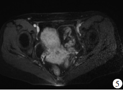 原发性盆腔腹膜后平滑肌瘤误诊为卵巢囊腺瘤一例