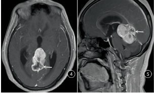 松果体区非典型性囊性脑膜瘤一例