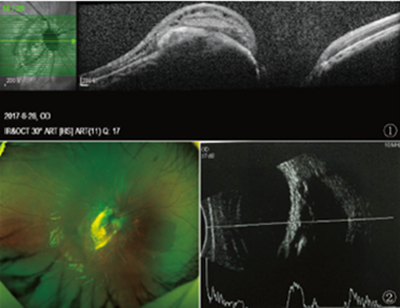 以内斜视首发的视神经胶质瘤误诊1例