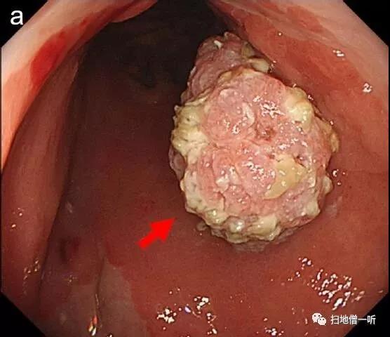 罕见病例：原发性胃疣状癌