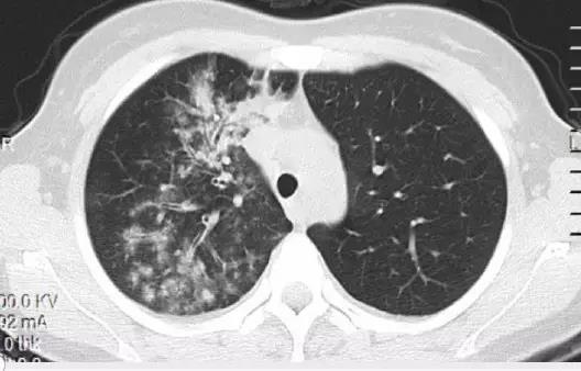 一<font color="red">句话</font>总结肺部感染的影像诊断！