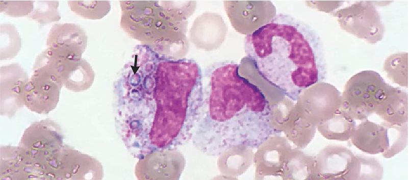 NEJM：<font color="red">播</font><font color="red">散</font><font color="red">性</font>组织胞浆菌<font color="red">病</font>-病例报道