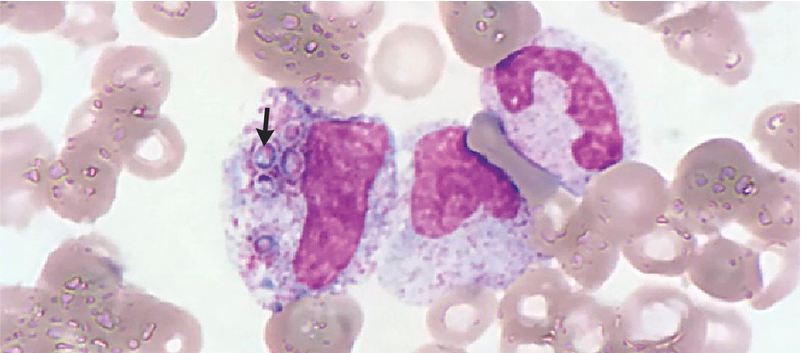 NEJM：播散性组织胞<font color="red">浆</font>菌病-病例报道