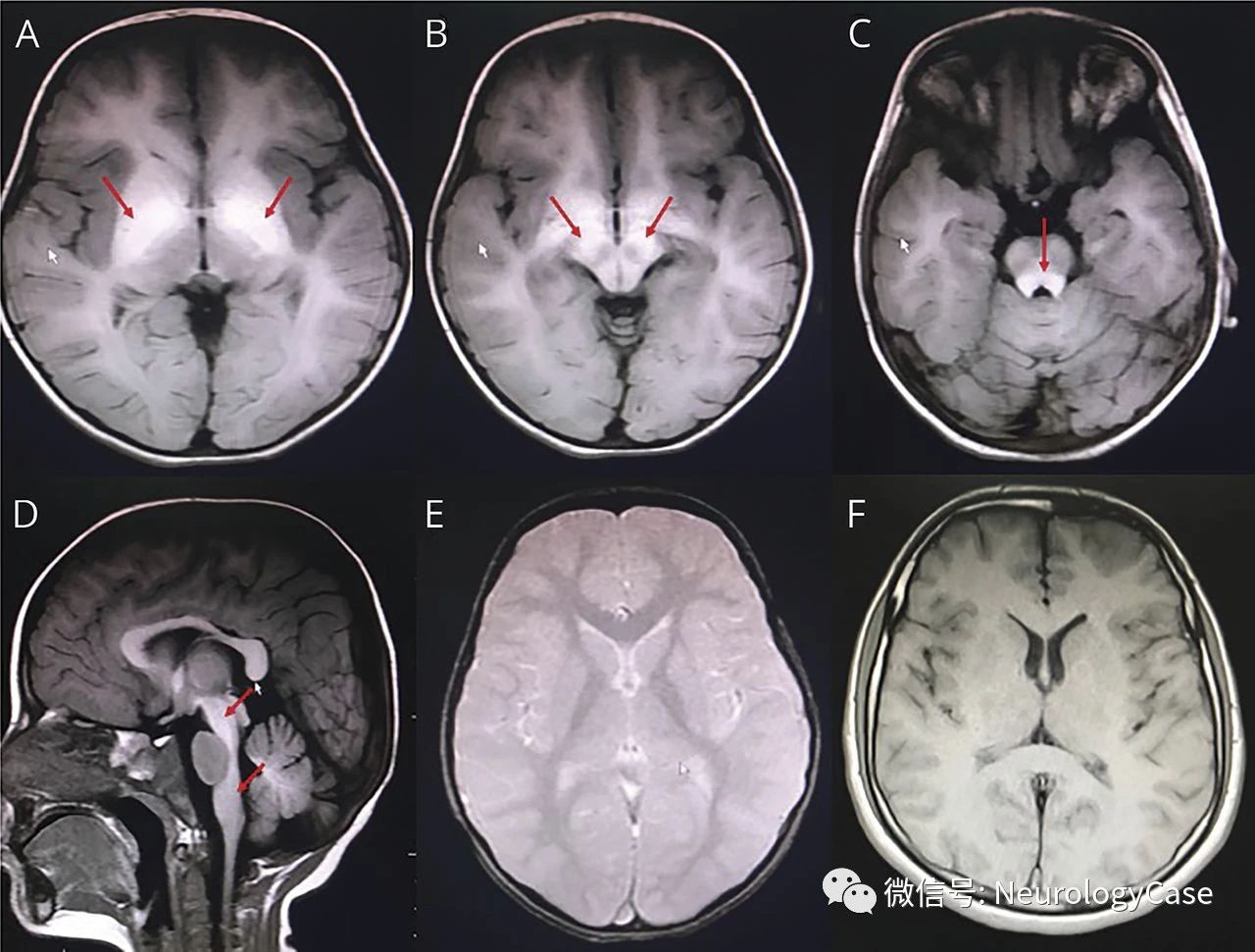Neurology:可治性儿童早期起病肌张力障碍的影像学线索：<font color="red">锰</font>中毒