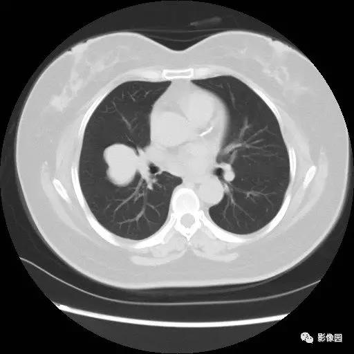 肺部CT检查发现右肺占位，请诊断