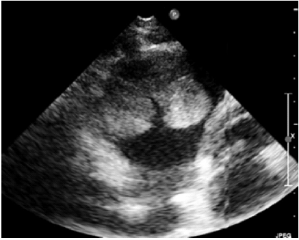 超声心动图诊断右心室黏液瘤1例