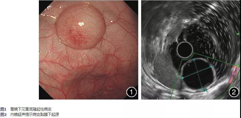 病例 | 内镜黏膜下剥离术治疗小儿胃重复畸形