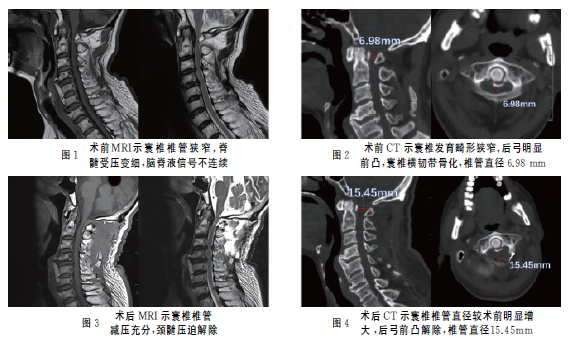 寰椎后路单开门椎管扩大成形术治疗寰椎发育畸形1例