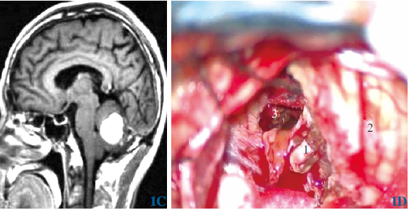老年小脑毛细胞型星形细胞瘤伴卒中1例
