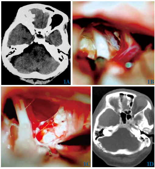 斜坡<font color="red">区</font>胆脂瘤致同侧三叉神经、舌咽神经痛2例