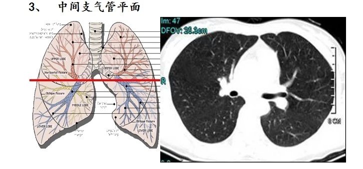 CT肺段定位口诀，图文结合异常清晰！