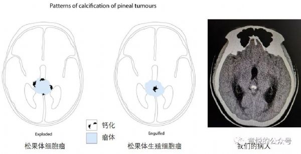 松果体细胞瘤图片