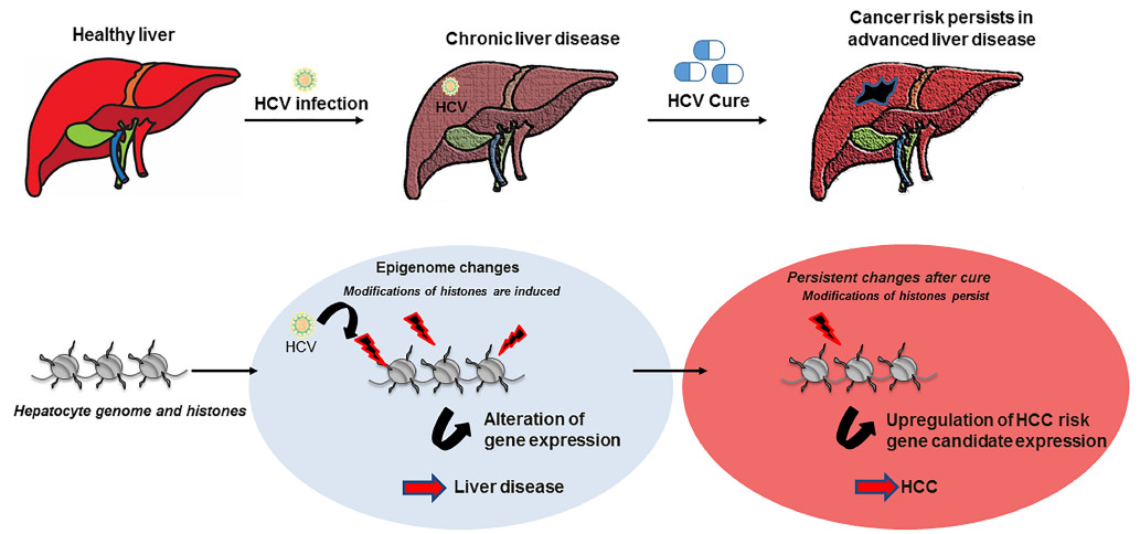 Gastroenterology：HCV感染引起的与肝癌风险相关的表观遗传改变在持续的<font color="red">病毒</font>学应答后持续存在