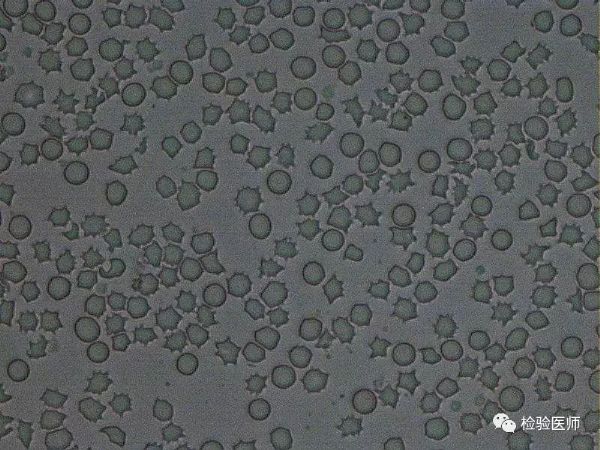 粪便中红细胞形态图片图片