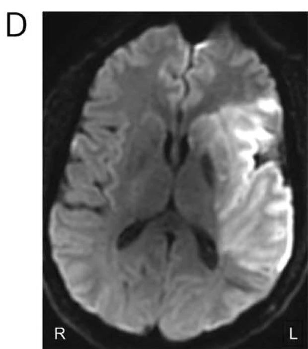 Neurology：脑电图捕捉到急性卒中