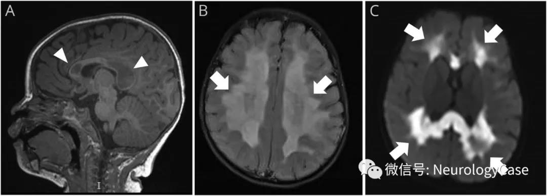 Neurology：婴儿空泡<font color="red">脑</font>白质病的MRI表现