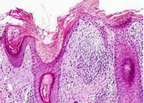 罗氏的AKT抑制剂ipatasertib联合PD-L1单抗和紫杉醇，显示出对三阴性乳腺癌的治疗前景