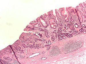 JCC： 泛素<font color="red">D</font>在IBD患者发炎的肠上皮细胞受Notch信号和TNF-α的协同作用上调