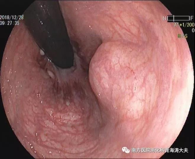 病例 | 内镜下切除直肠肛管附近4cm巨大间质瘤