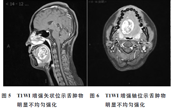舌部良性肿瘤神经鞘<font color="red">瘤</font>的MRI表现1例
