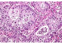 <font color="red">JAMA</font>：非小细胞肺癌患者肿瘤突变特征与预后