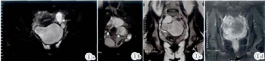 陈旧性宫外孕表现为巨大盆腔<font color="red">包</font>块的MRI诊断2例