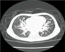儿童弥漫性肺淋巴管瘤病1例
