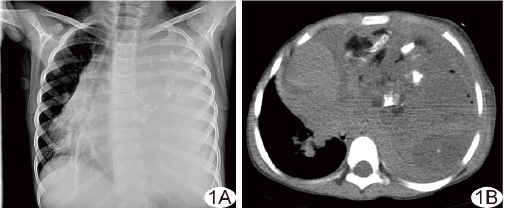 左侧胸腔巨大成熟畸胎瘤1例