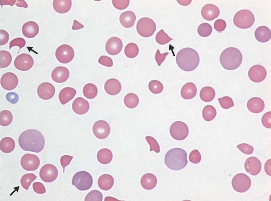 NEJM：血栓性血小板减少性紫癜-病例报道