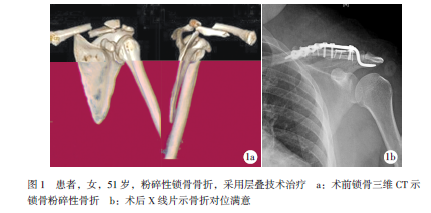层叠技术治疗粉碎性锁骨骨折1例