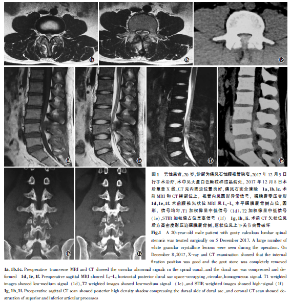 手术治疗痛风石性腰椎管狭窄1例