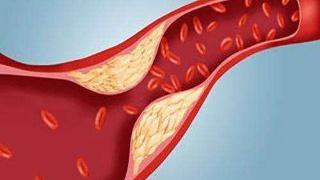 DDS： 动态甘油三酯水平对高甘油三酯血症性胰腺炎患者复发风险的影响