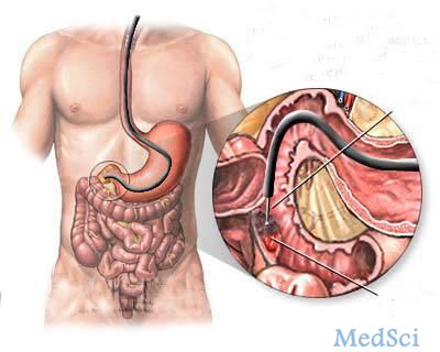 DDS： 双气囊小肠镜检查对明显小肠出血的短期和远期疗效的影响