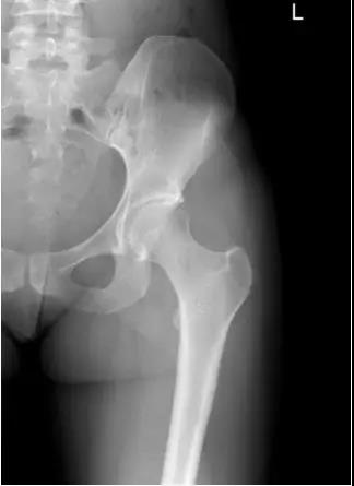 Sicot J：一例典型的运动过量出现的股骨颈应力性骨折