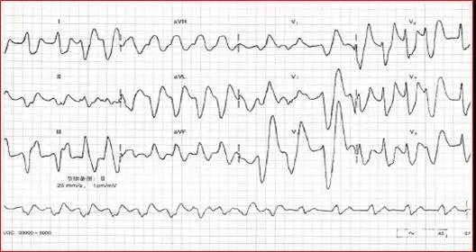 血钾<font color="red">异常</font>的心电图表现，最经典的在这里！