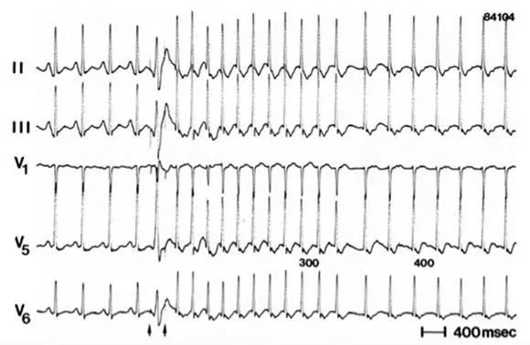 一张心电图记录了两种心动过速，该如何诊治？
