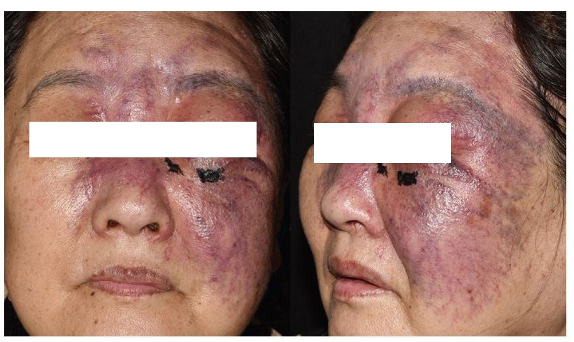 老年女性患者面部紫罗兰色肿胀伴毛细血管扩张和坏死1例