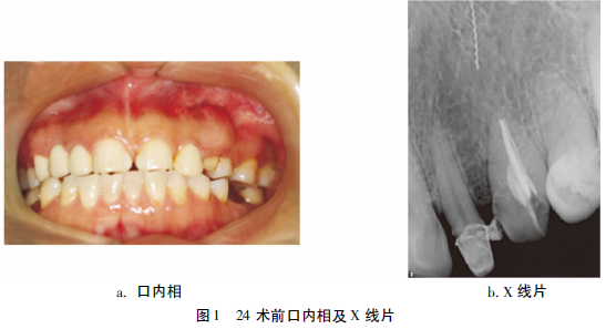 錐形<font color="red">束</font><font color="red">CT</font>輔助定位根管外器械分離1例