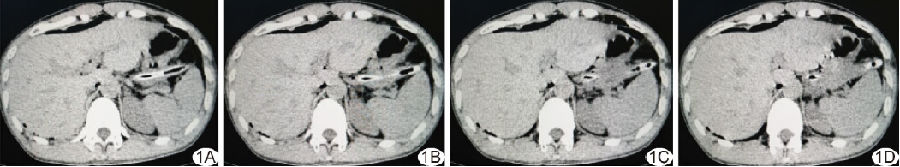 CT误诊小肠克罗恩病合并肠穿孔1例