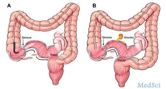 J Gastroenterology：连锁彩色成像可通过与周围胃肠化生的高颜色对比增强对早期胃癌的识别效能