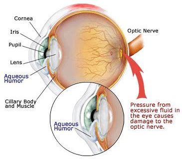2019年ARVO：青光眼长期治疗取得新进展
