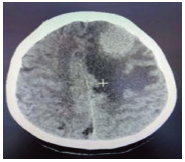 头CT酷似脑膜瘤的泡型脑包虫病1例