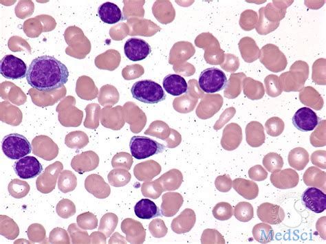 慢性<font color="red">淋巴细胞</font>白血病：Calquence达到III期临床试验的主要终点